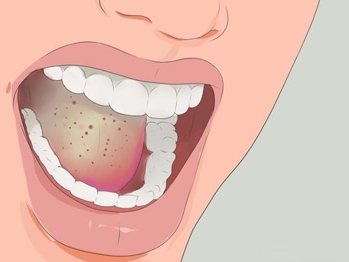 Sáng ngủ dậy có máu trong miệng là dấu hiệu gì? Nguyên nhân và cách xử lý đúng 60 Sáng ngủ dậy có máu trong miệng
