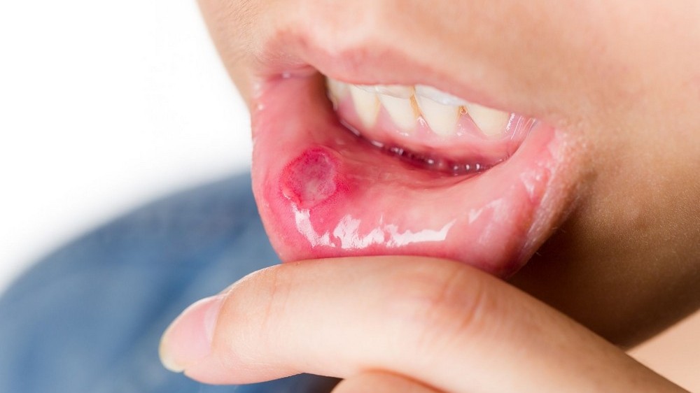 Sáng ngủ dậy có máu trong miệng là dấu hiệu gì? Nguyên nhân và cách xử lý đúng 61 Sáng ngủ dậy có máu trong miệng